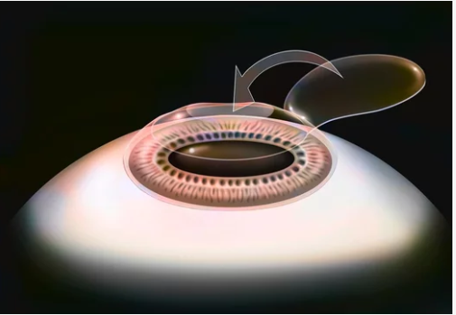 Best LASIK Eye Surgery in Chembur